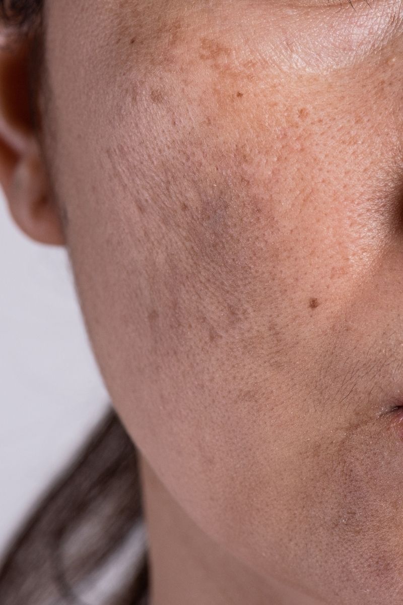 Managing Melasma: Prevention, Treatment, and Lifestyle Tips